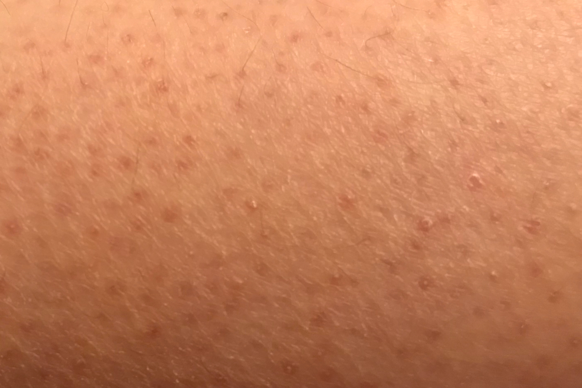 Keratosis Pilaris undefined